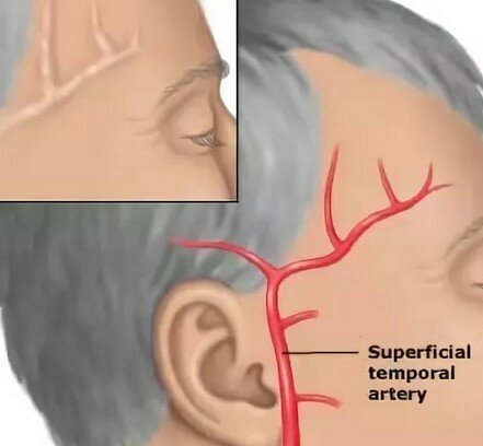 Третий день болит правый висок головы
