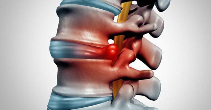 По утрам болит спина в области поясницы справа