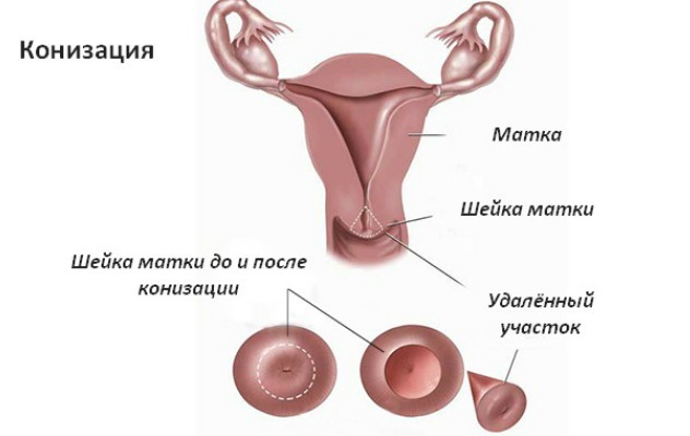Болит после конизации спина