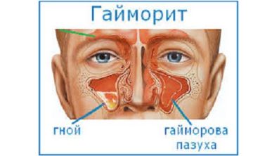 Болит спина и невысокая температура что это такое