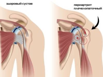 болит голова шея и левая рука