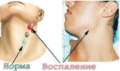 Болит спина и невысокая температура что это такое