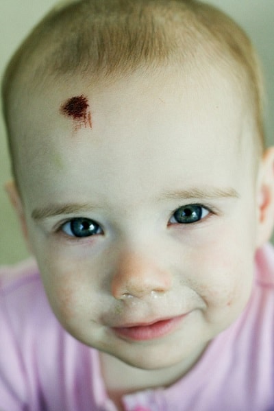 красное пятно малыш пострадал