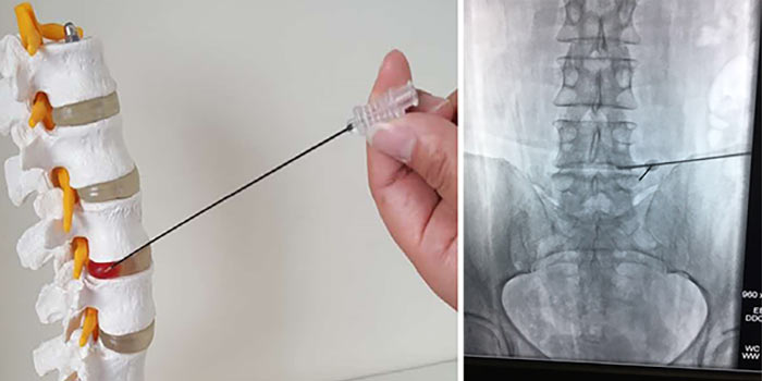 У меня рак матки поработала болит спина сильно