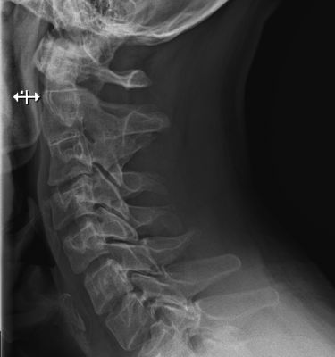 Сильная боль в голове до дрожи