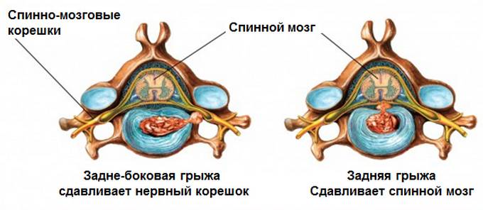 Межпозвоночная грыжа может сдавливать не только отдельные нервные окончания, но и спинной мозг, если выходит в позвоночный канал